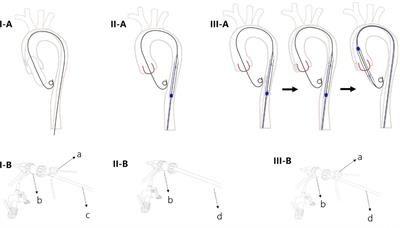 Single femoral artery access is safe and feasible during transcatheter aortic valve replacement: a propensity score matched analysis